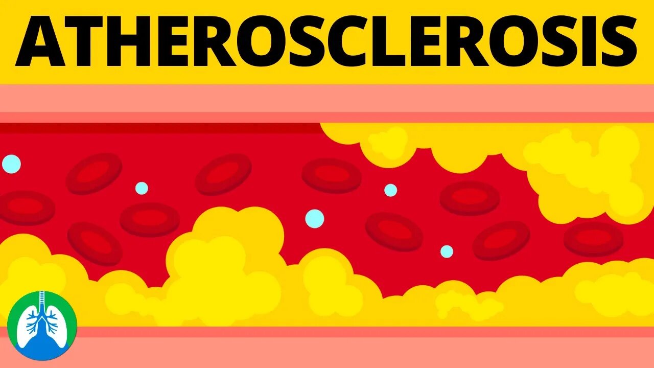 Atherosclerosis (Medical Definition) | Quick Explainer Video