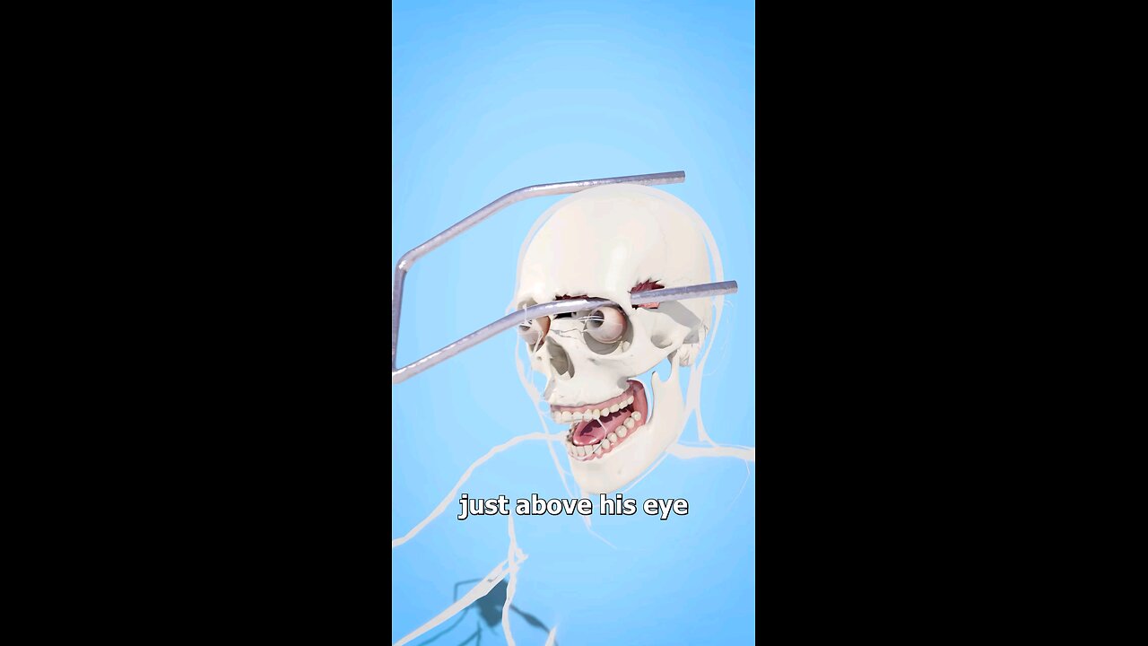 Surviving A Rod Through The Head 🤕