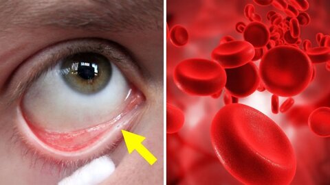 Como Saber se Você está com Anemia? Veja 8 Sinais Que Você Não Deve Ignorar