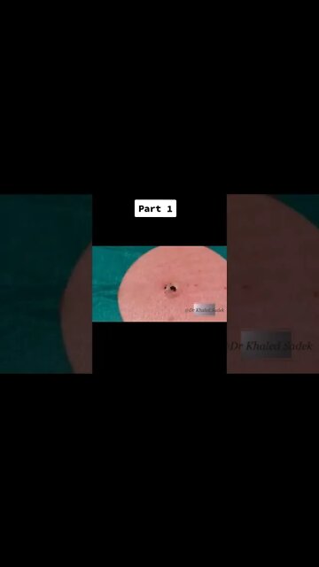 #blackheadsremoval #blackhead #satisfying #viral