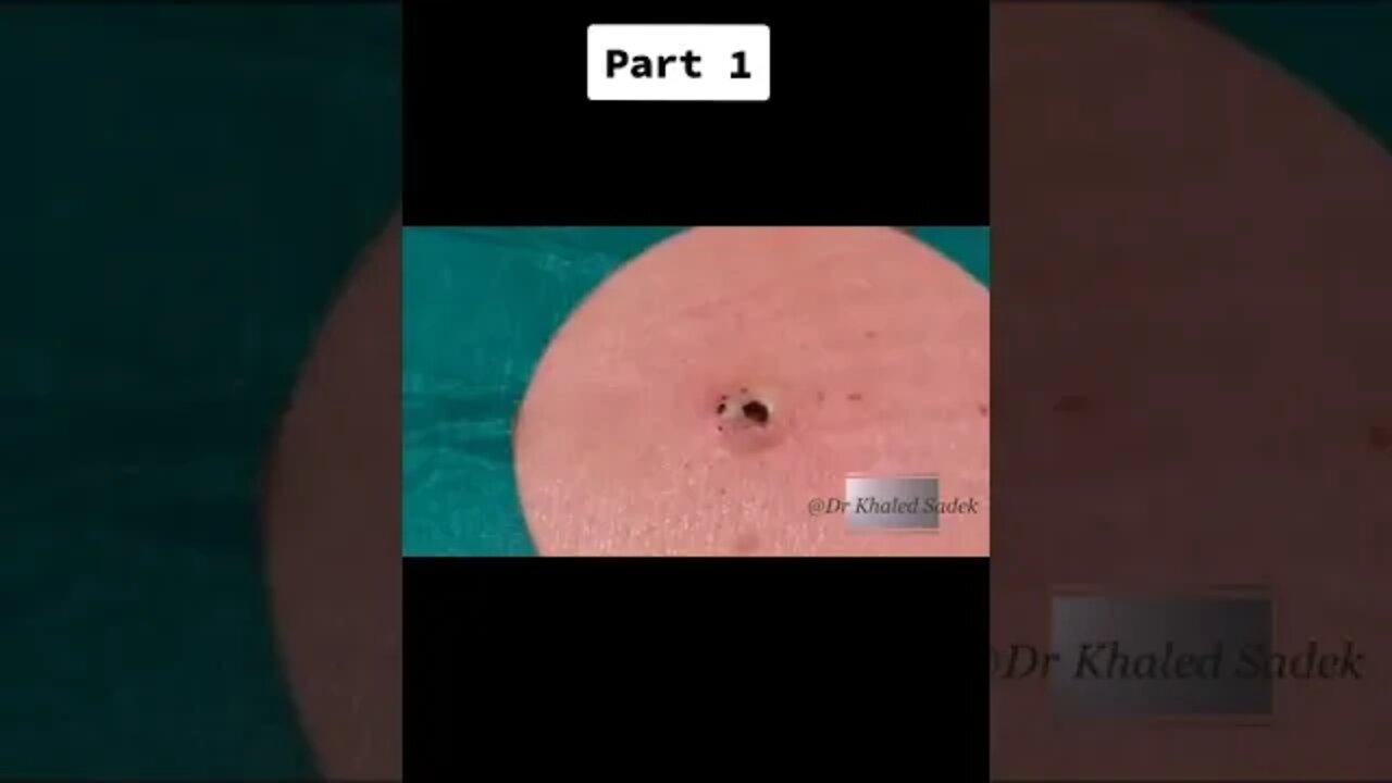 #blackheadsremoval #blackhead #satisfying #viral