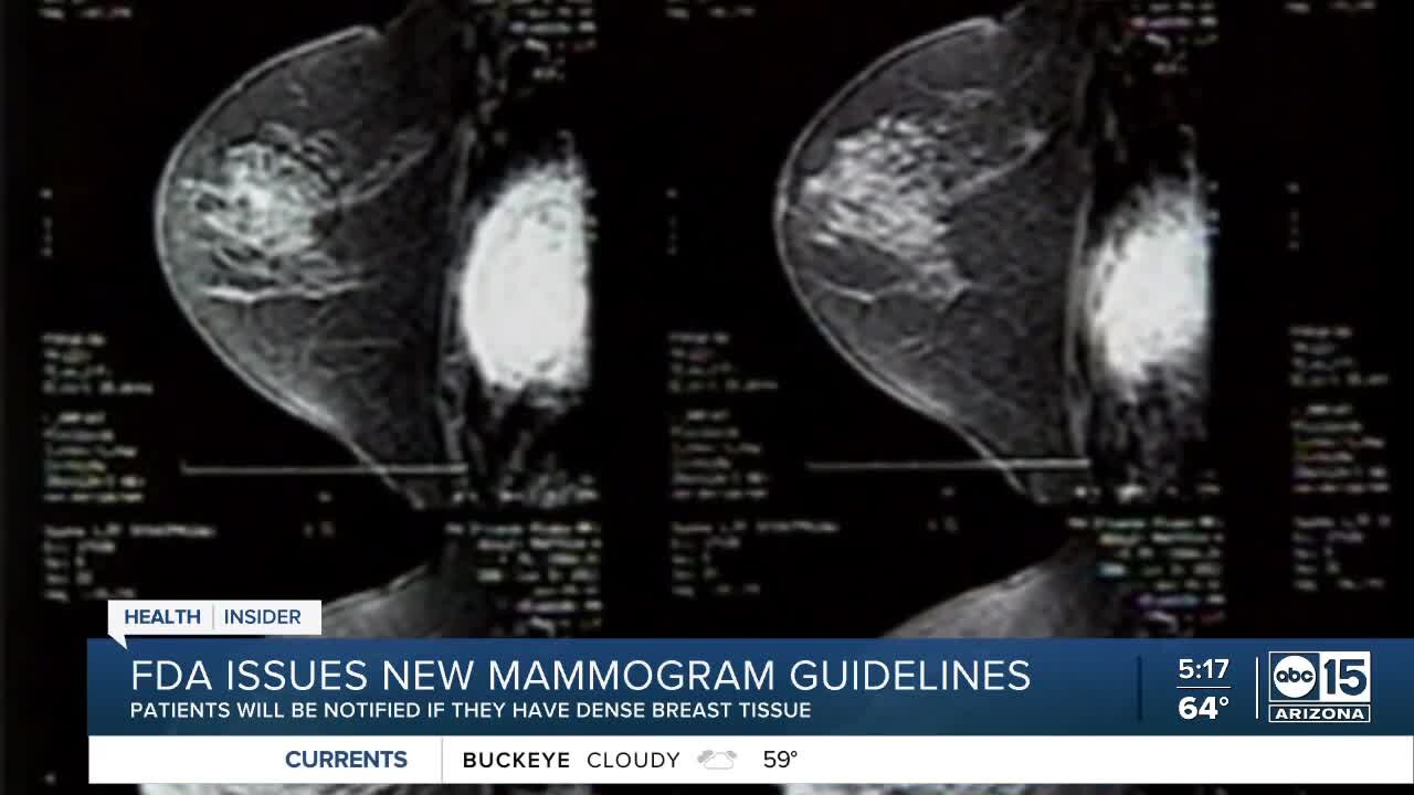 FDA issues new mammogram guidelines