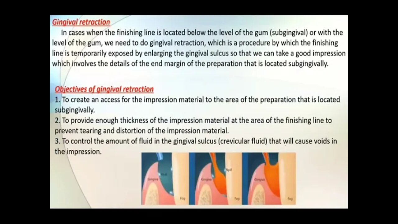 Operative L16 (Fixed Prosthodontics:Gingival Retraction & Impression Techniques)