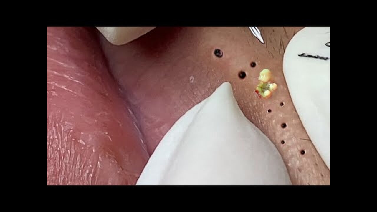 Big Cystic Acne Blackheads Extraction Blackheads & Milia, Whiteheads Removal Pimple Popping