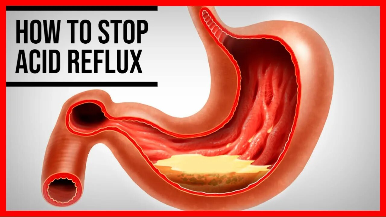 3 Home Remedies for Acid Reflux That Really Work