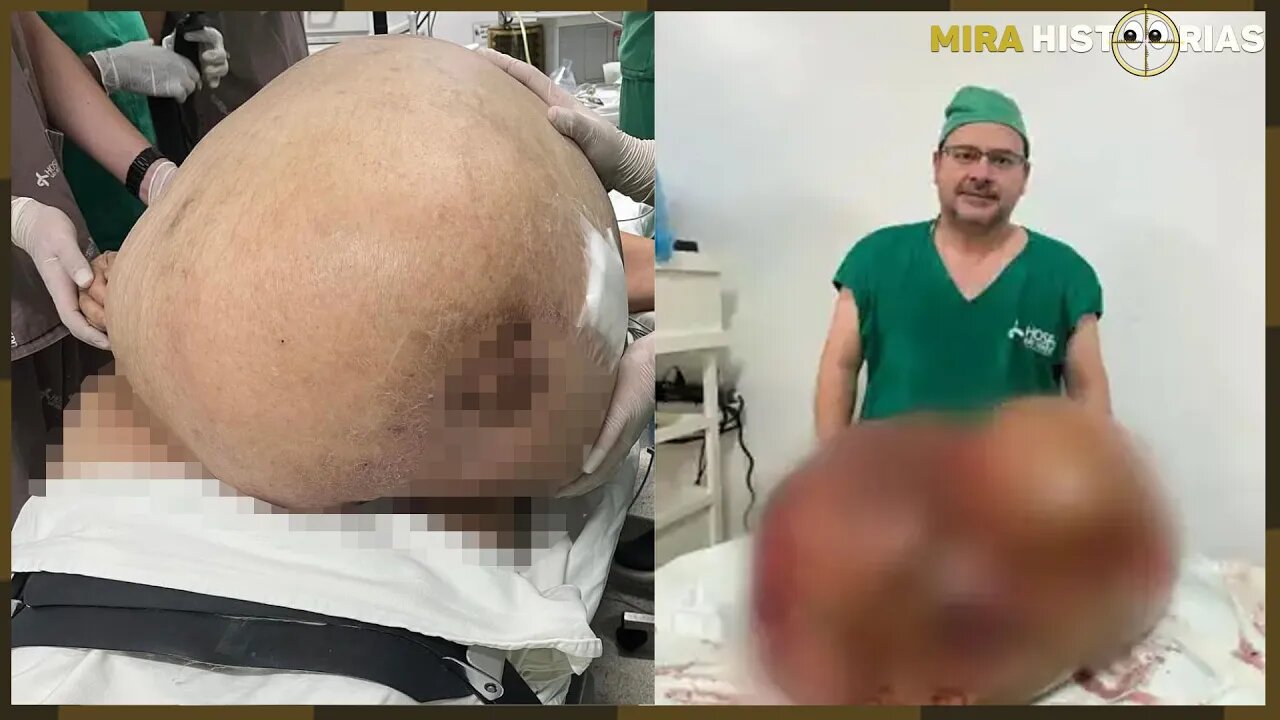 Ela pensou que estava "engordando muito". Mas o que removeram dela, os médicos nunca viram parecido