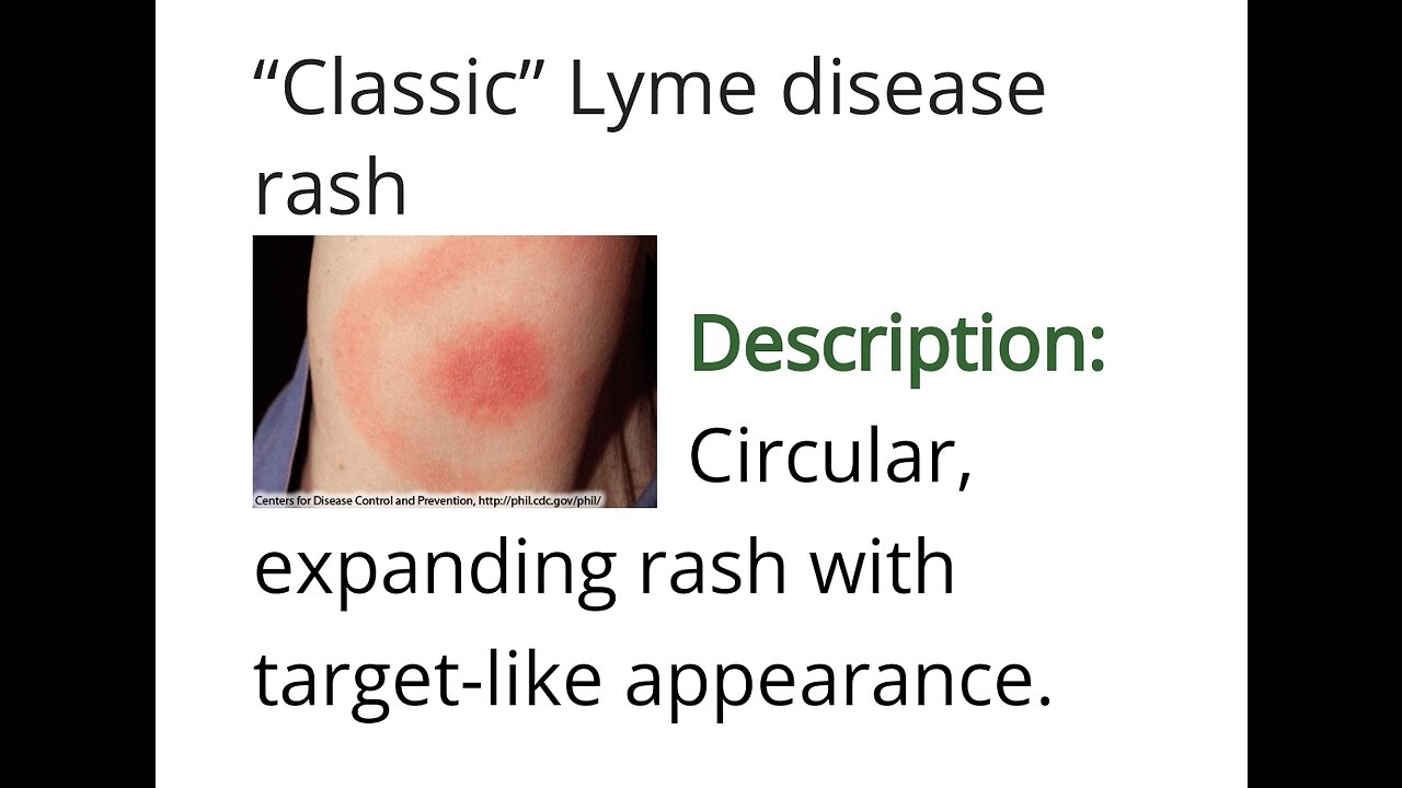 You aren't Crazy ~ You just have Lyme disease