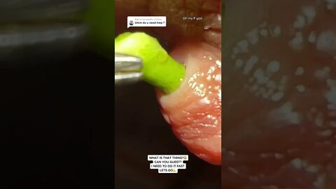 Mysterious green hair removal under skin 🤮 - blackheads removal