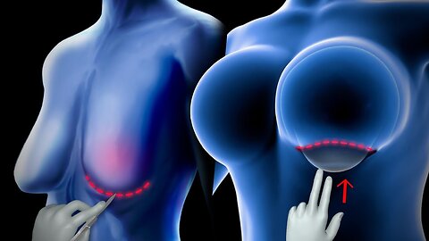 How breast enlargement surgery is carried out#BreastEnlargement #BreastSurgery