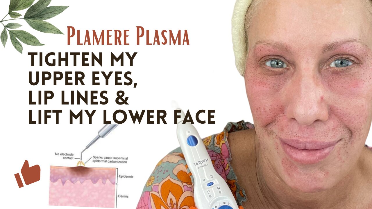 Plamere Plasma Pen - Let's Discuss my Fibroblast Skin Tightening