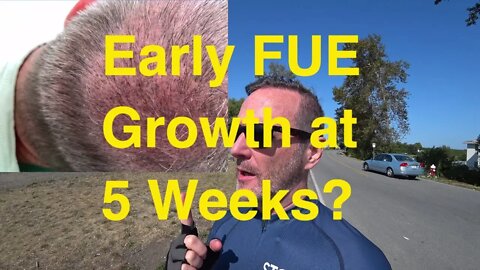 Joe Tillman FUE Hair Transplant Five Week Update w/ Dr. Wong