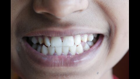 Achieve Your Dream Smile with Teeth Straightening