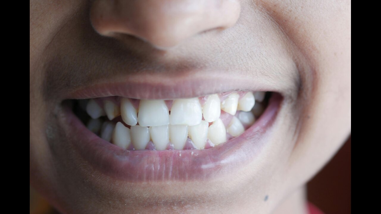 Achieve Your Dream Smile with Teeth Straightening