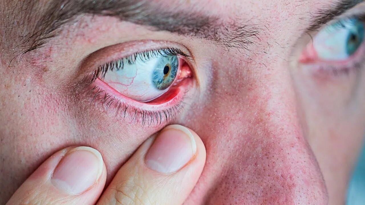 Dry Eyes? Here's What They Reveal About Your Health