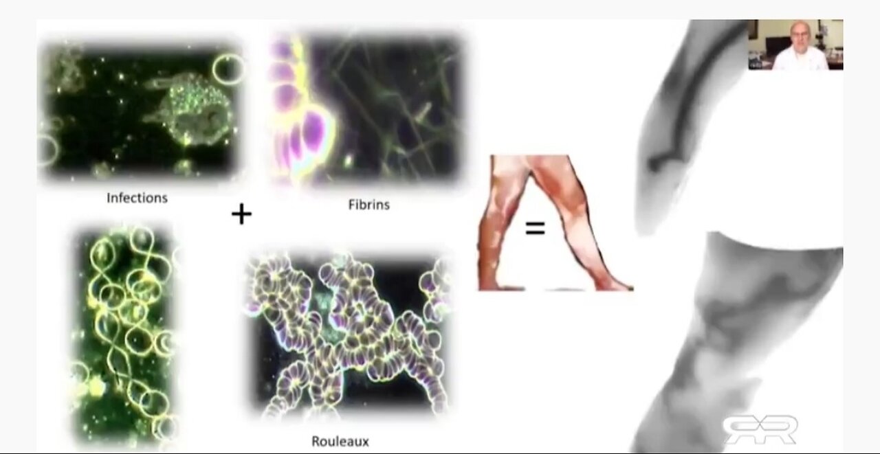 THERMOGRAPHIC IMAGING SHOWS MASSIVE BLOOD CLOTS IN THE ASYMPTOMATIC VAXXED