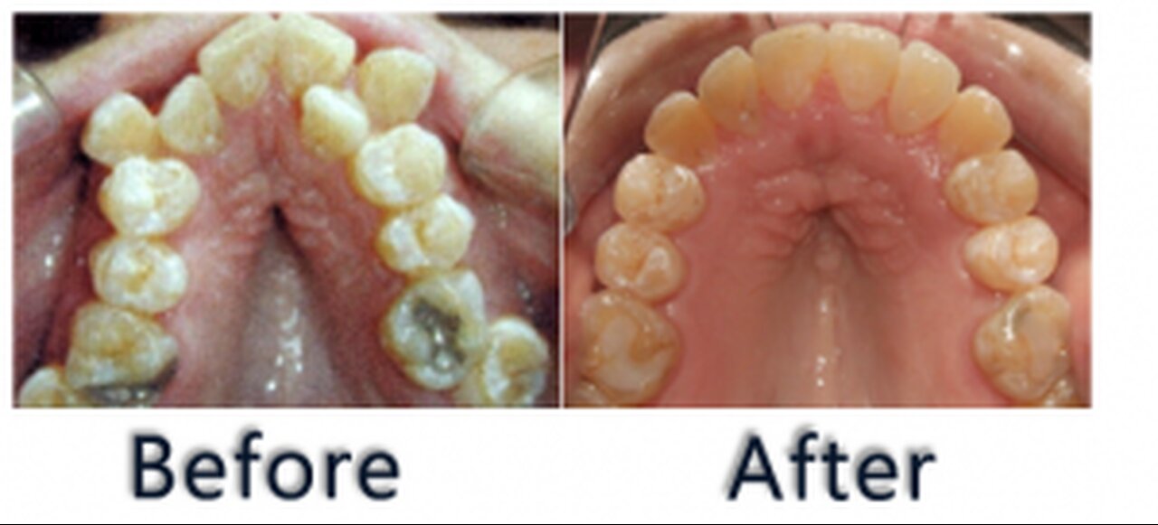 21. Widening of the Upper Jaw with Semi Rapid Expansion in Orthodontics by Prof John Mew