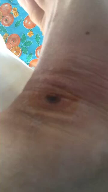 Cured MRSA infection with Chlorine Dioxide