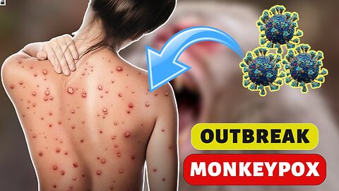 Everything you need to know about monkeypox