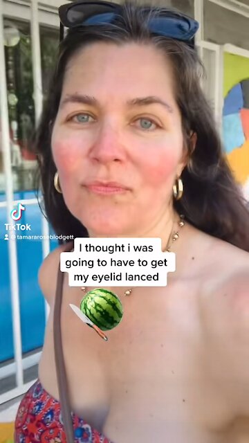 No lancing; just ocular rosacea BS 🙄