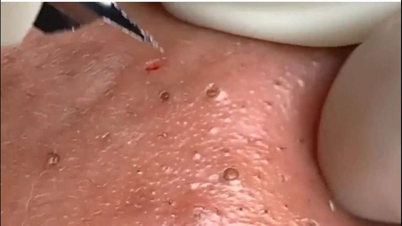 Insane!!Extraction!!
