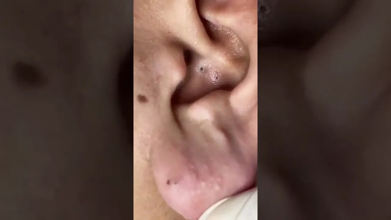 Disgusting Blackheads Ear Removal