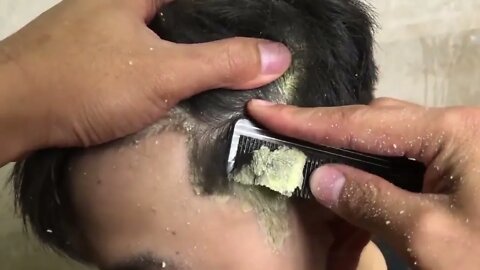 Seriously infected scalp. So thick dandruff. | Oddly Satisfying Videos