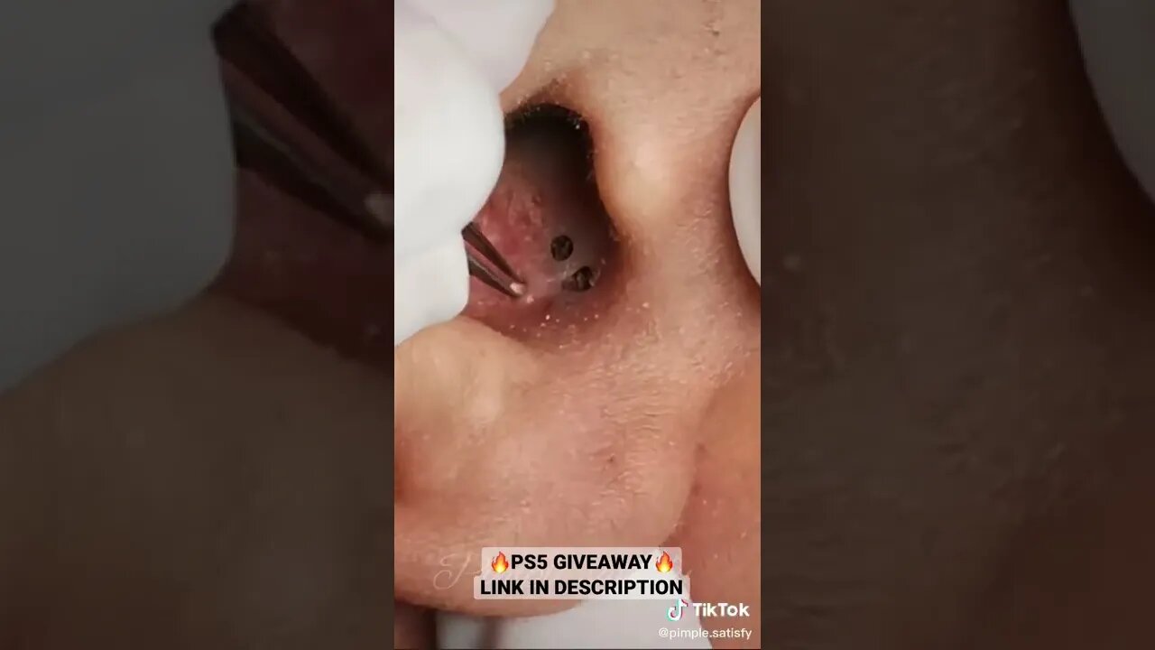 Crazy blackheads inside ear 👂they don’t want to come out #shorts #blackheads #blackheadremoval