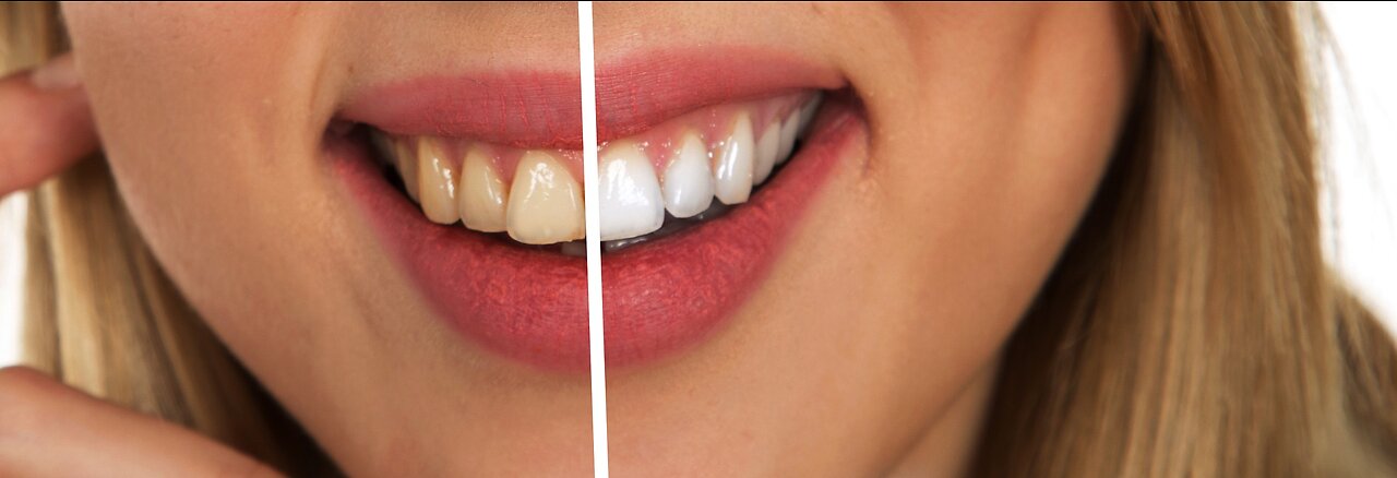 Cleaner Smile | Get The Smile You Have Always Dreamed Of!