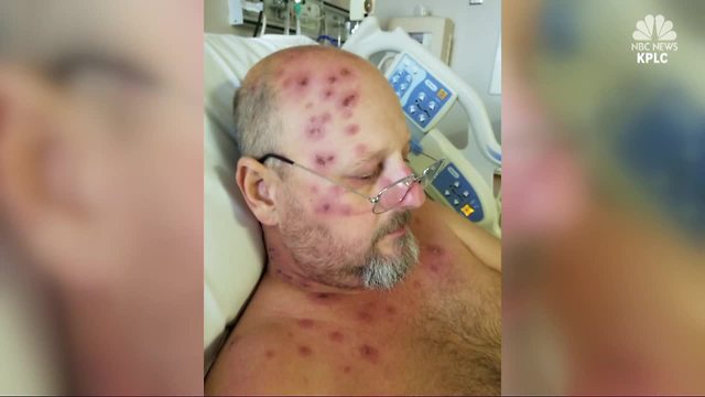 Sinus infection turns into a mystery illness for Louisiana man