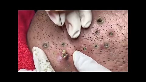 Satisfying blackhead removal, relaxing Pimple Popper 5467