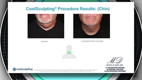 MD Body And Med Spa- Summer Sip and Sculpt