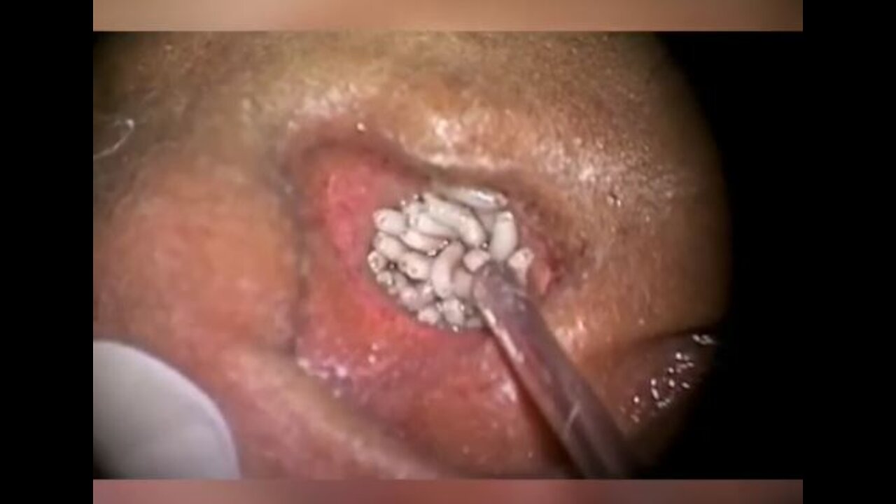 THOUSANDS of Botflies Maggot Removed - How did they go there?