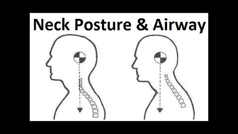 Chronic Cerebrospinal Venous insufficiency (CCSVI), Brendan Stack & Craniofacial Dystrophy p2