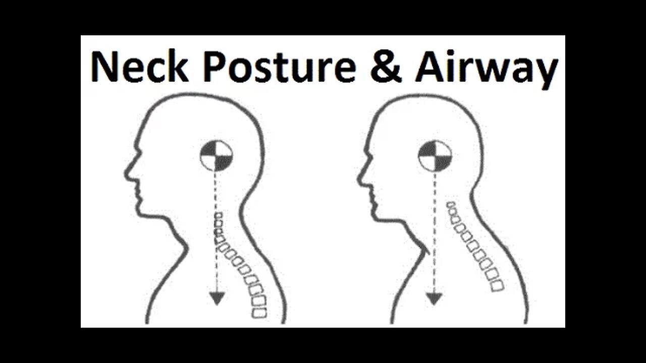 Chronic Cerebrospinal Venous insufficiency (CCSVI), Brendan Stack & Craniofacial Dystrophy p2