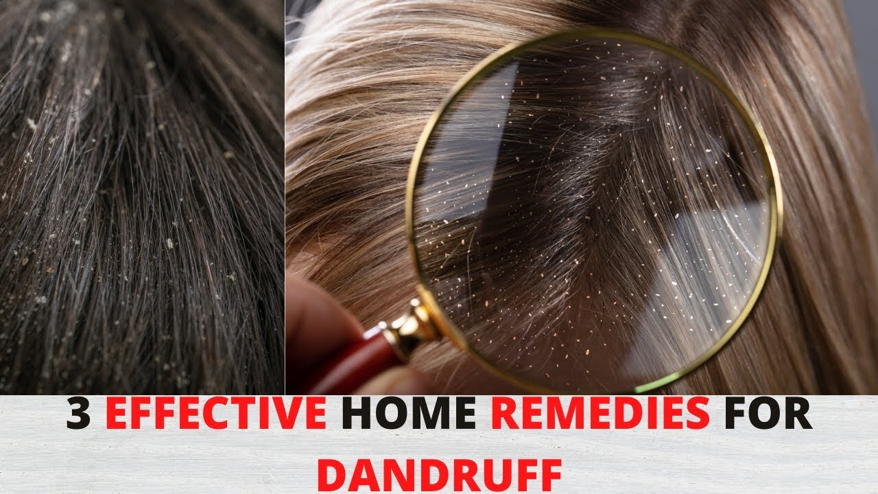 3 Effective Home Remedies for Dandruff