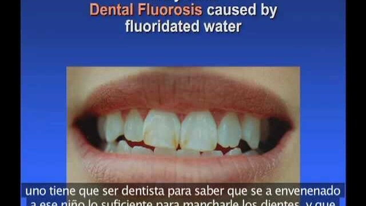 Effects of Fluoride by David Kennedy, DDS, MIAOMT and Kathleen Thiessen, PhD