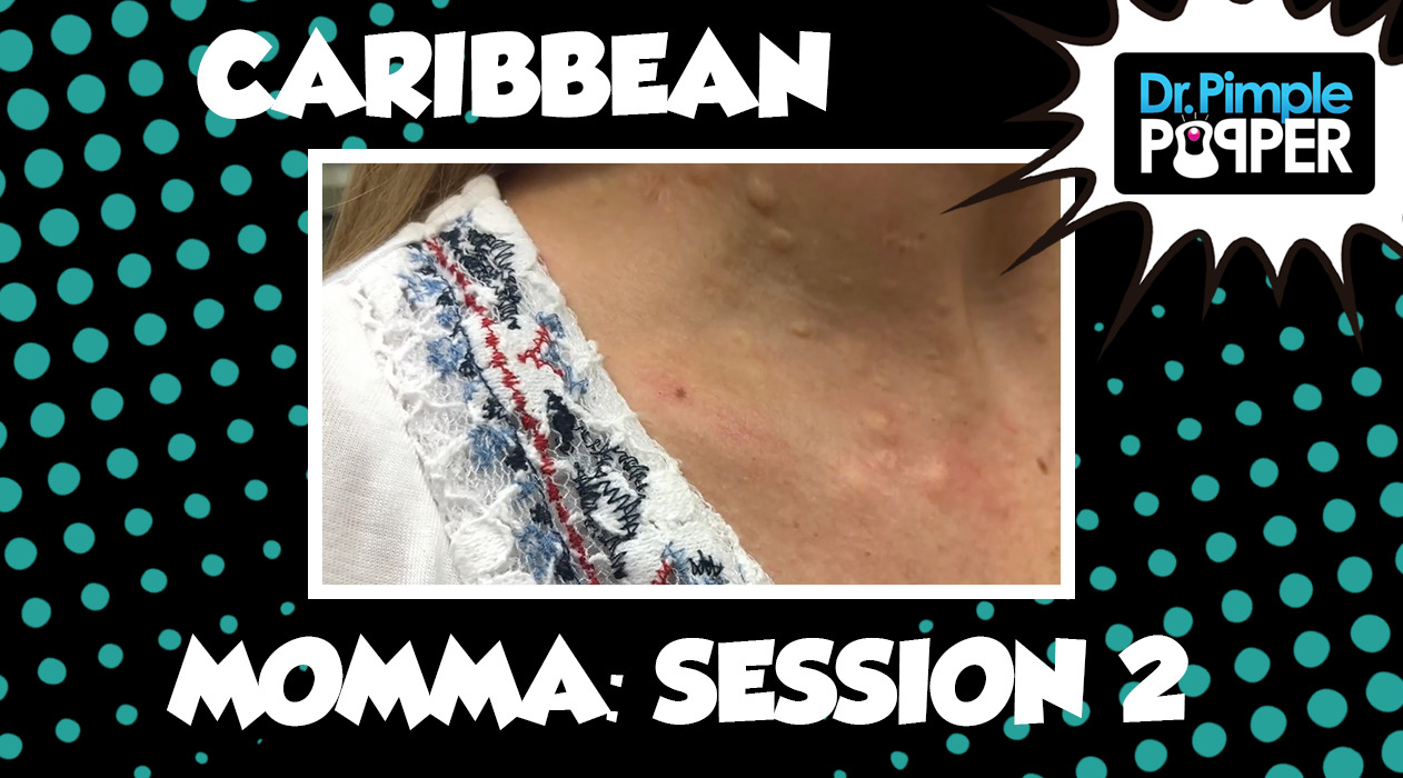 Caribbean Momma Steatocystomas: Session Two, Part One