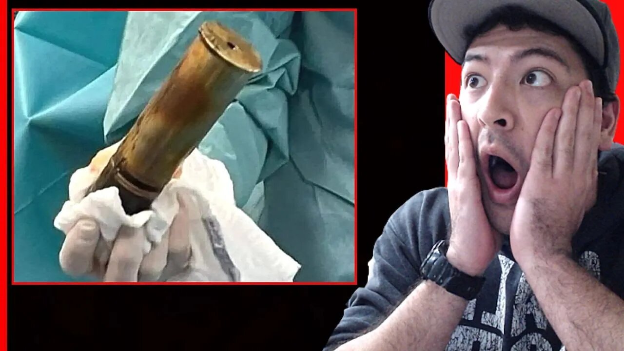 WWI EXPLOSIVE STUCK INSIDE MAN'S BUTT