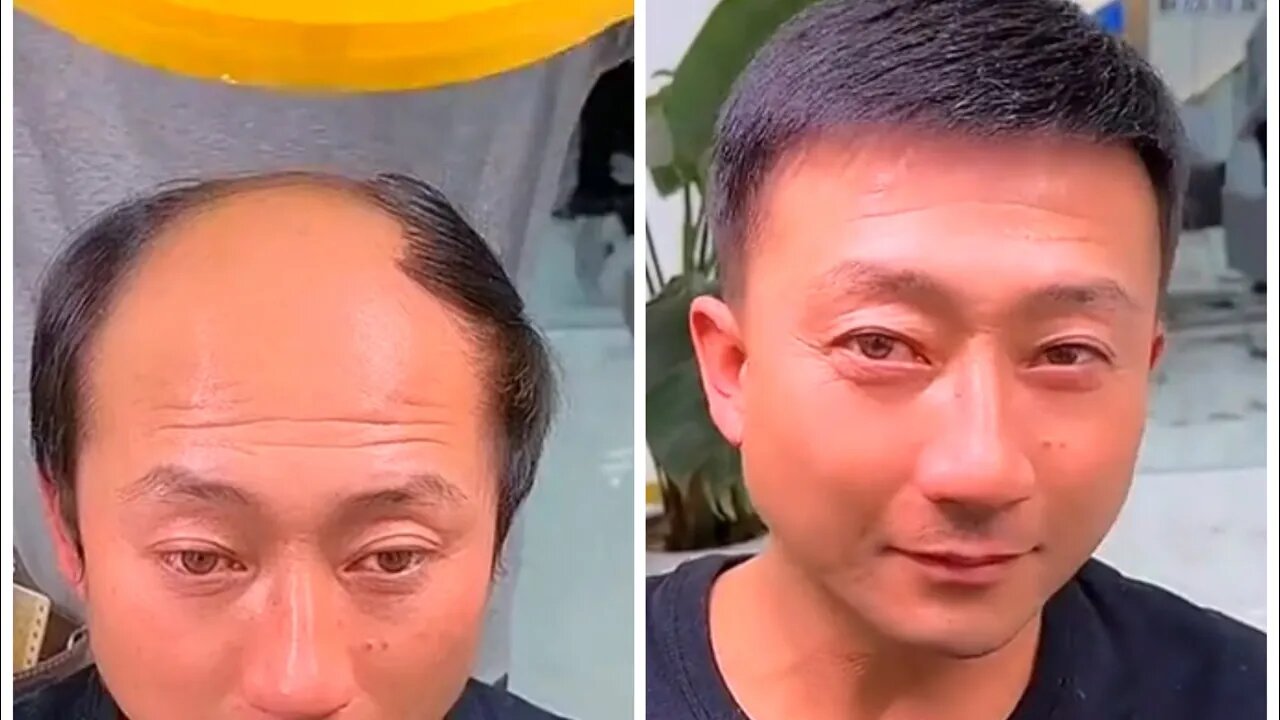 Hair transplantation amazing result #shorts #fyp #viral #fashion #respect