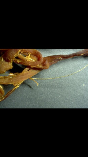 VACCINES ARE CAUSING SUDDEN ADULT DEATH SYNDROME