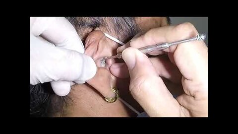 Earwax removal