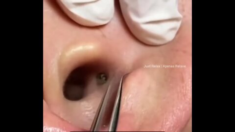 Remoção de Cravos na Orelha #04 - Removal of Blackheads in the Ear - Vídeo Satisfatório - Just Relax