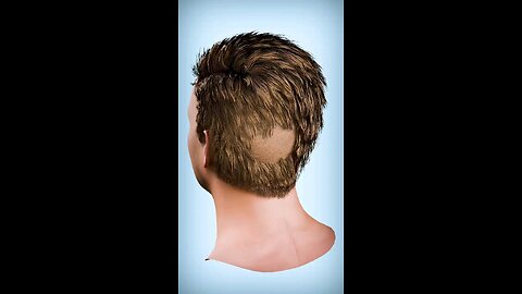 How Hair Transplant works