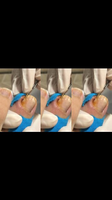 It must have been a relief after the removal of ingrown toenail.