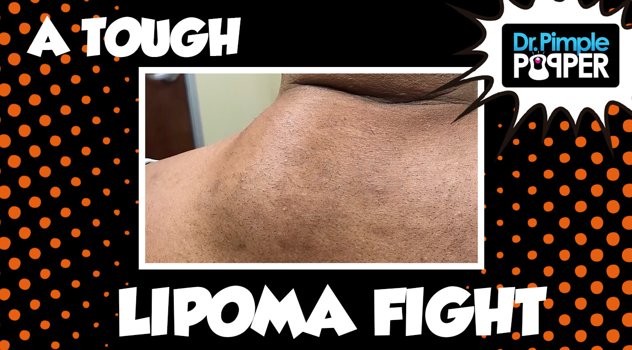 I Fought the Lipoma...the Lipoma Almost Won...