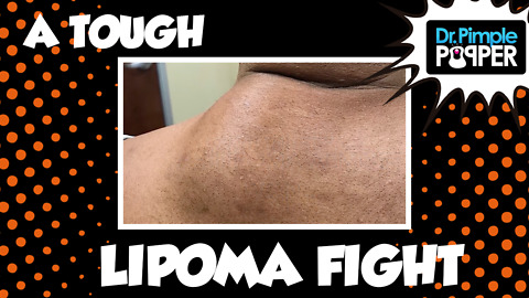 I Fought the Lipoma...the Lipoma Almost Won...