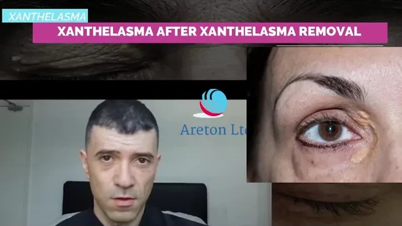 XANTHELASMA AFTER XANTHELASMA REMOVAL