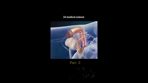 Surgical operation animated video pt 2