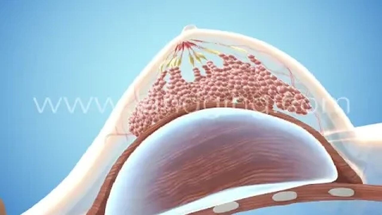 Breast Augmentation Animation