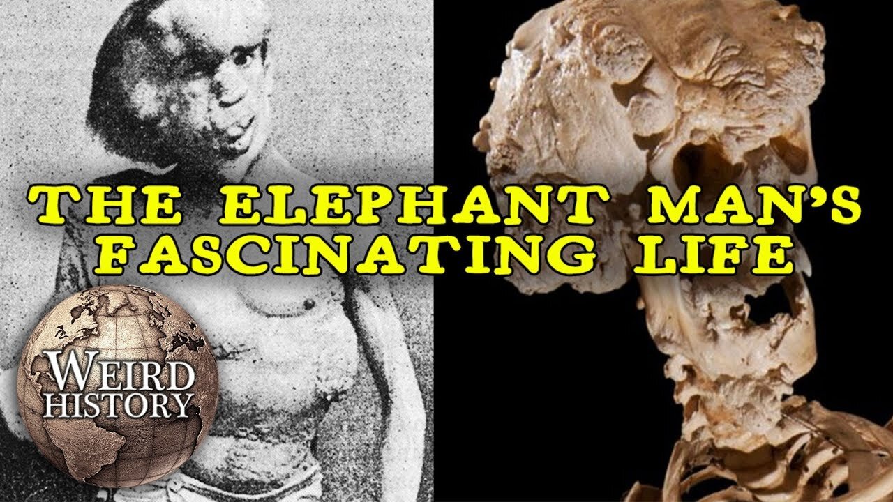 The Elephant Man - The Weird & Tragic Story of Joseph Merrick